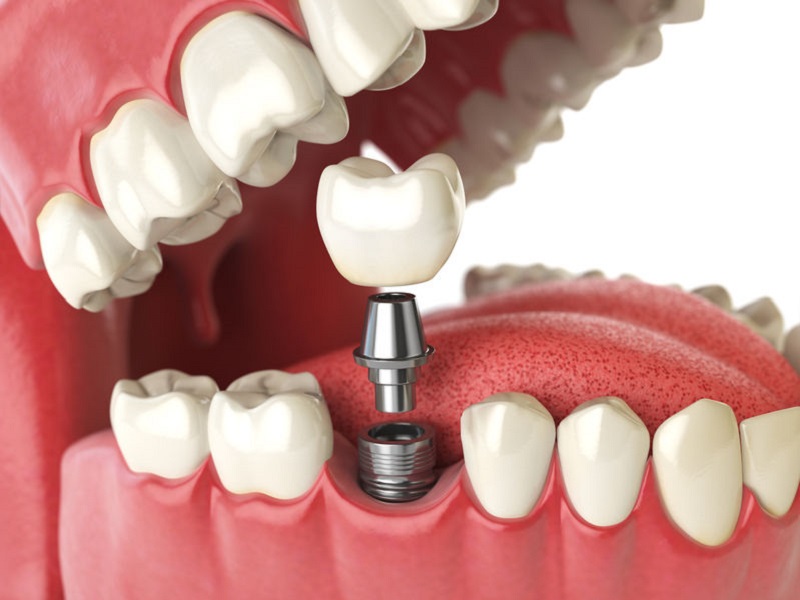 Implanty zębów Olsztyn